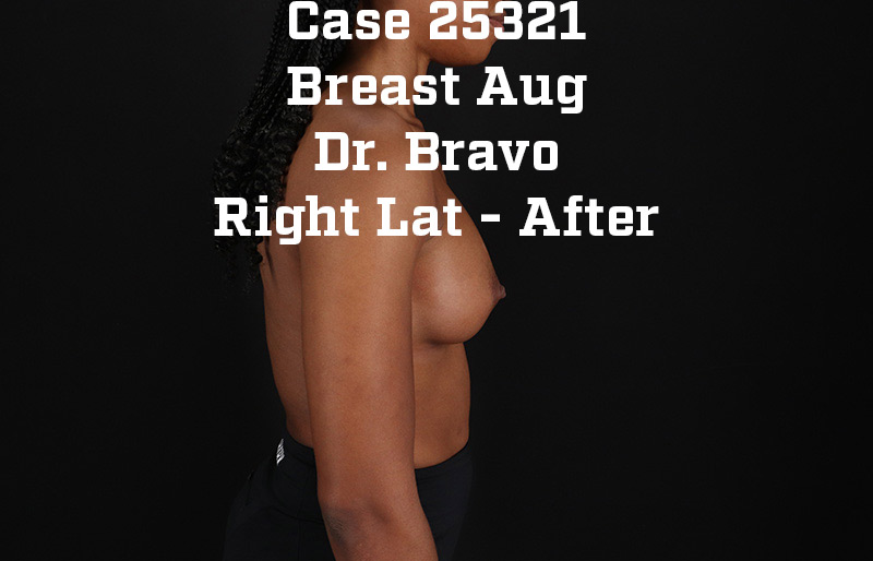 After - right_lateral