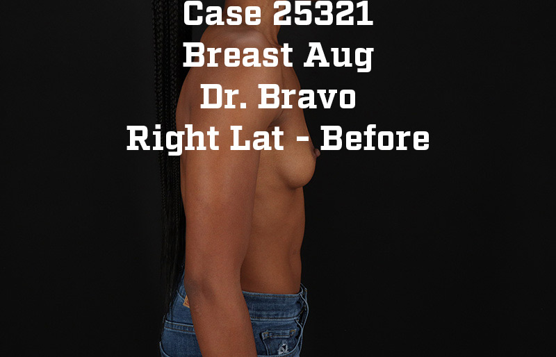 Before - right_lateral