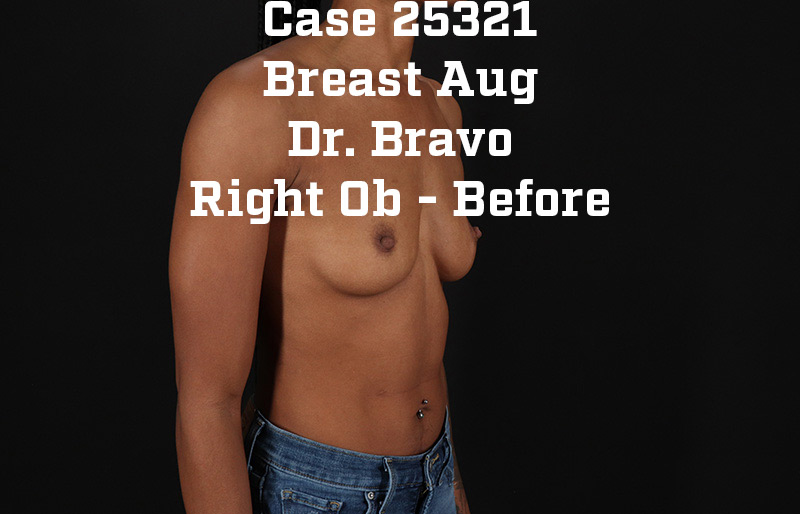 Before - right_oblique