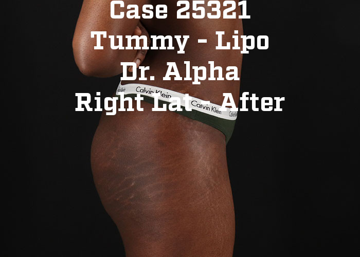 After - right_lateral