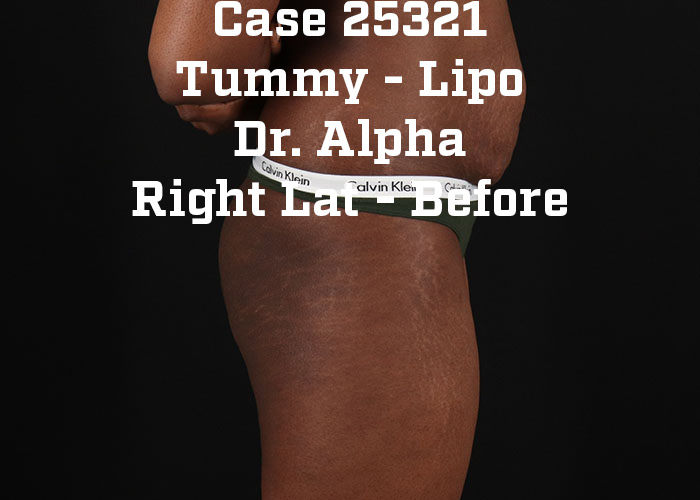 Before - right_lateral