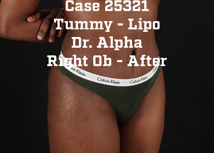 After - right_oblique