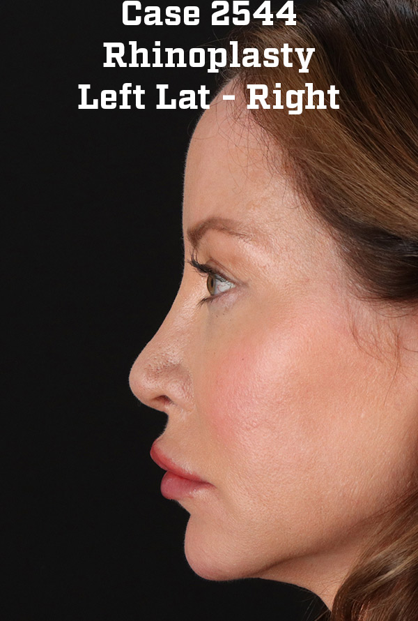 After - left_lateral