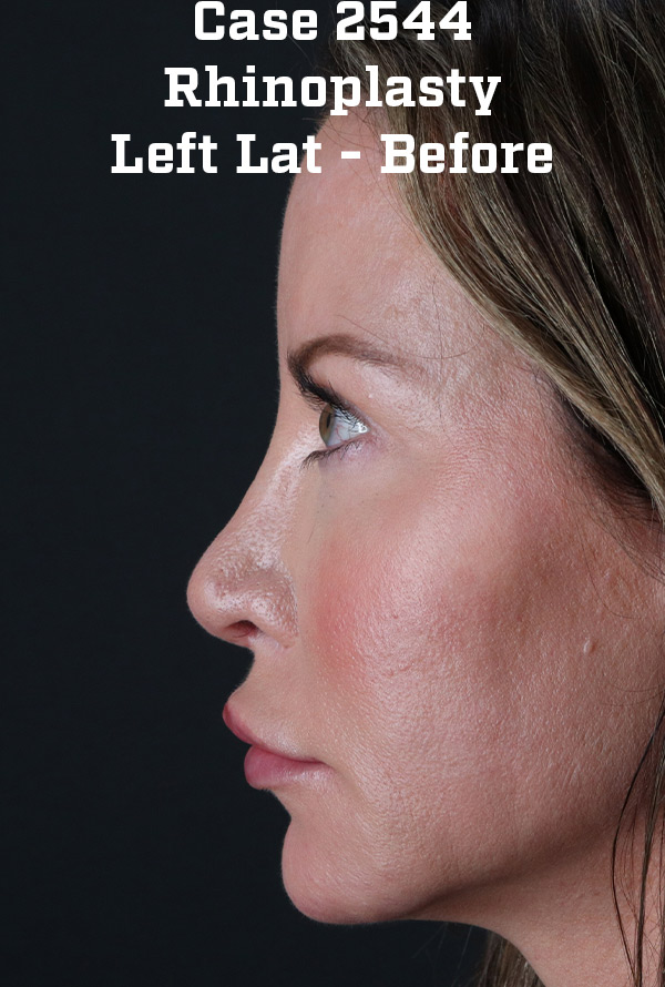 Before - left_lateral