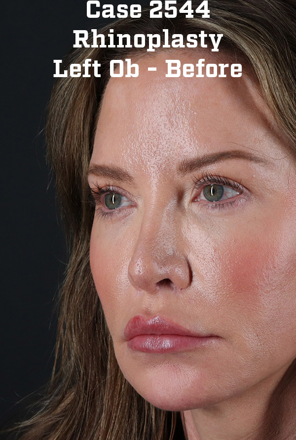 Before - left_oblique