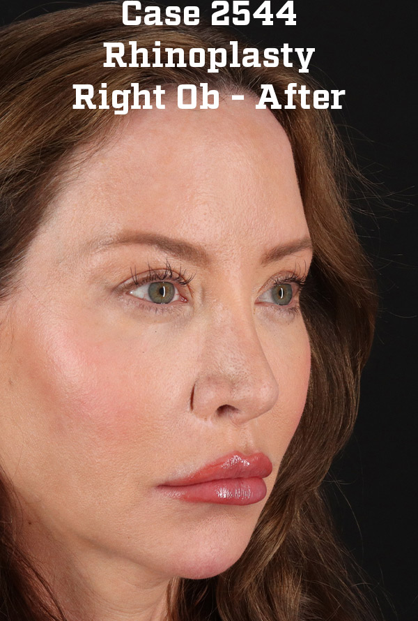 After - right_oblique