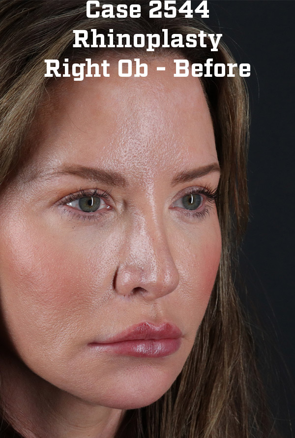 Before - right_oblique