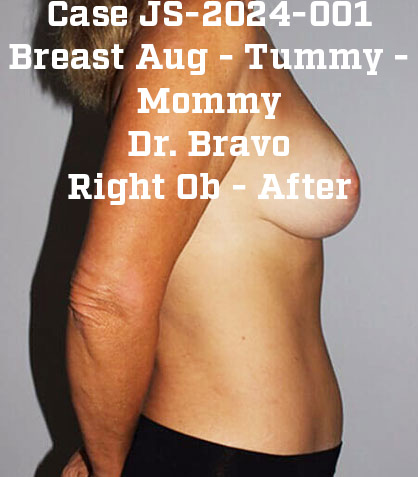 After - right_lateral