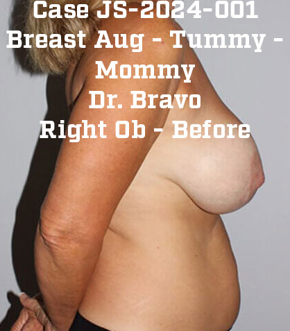 Before - right_lateral