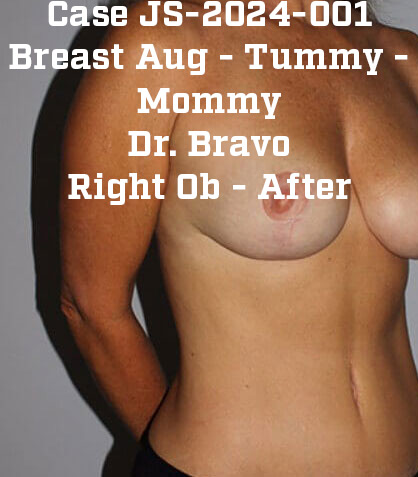 After - right_oblique