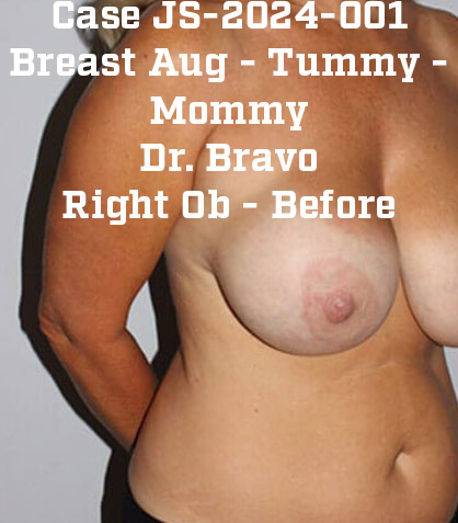 Before - right_oblique