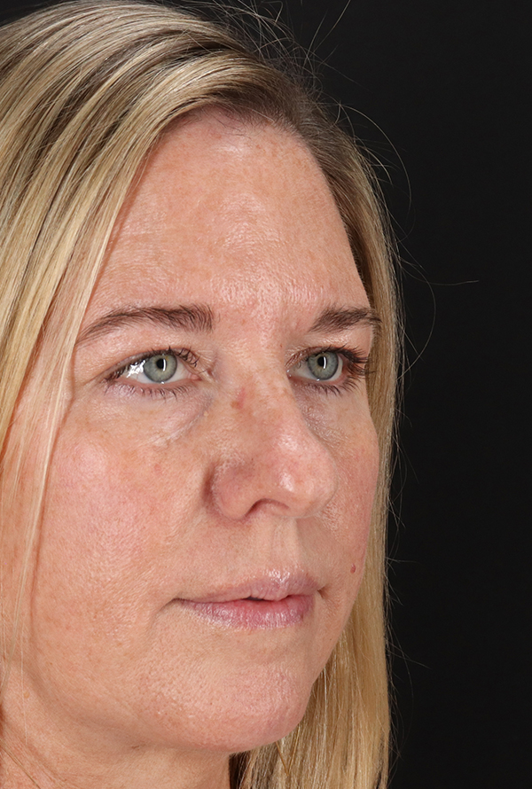 Before - right_oblique