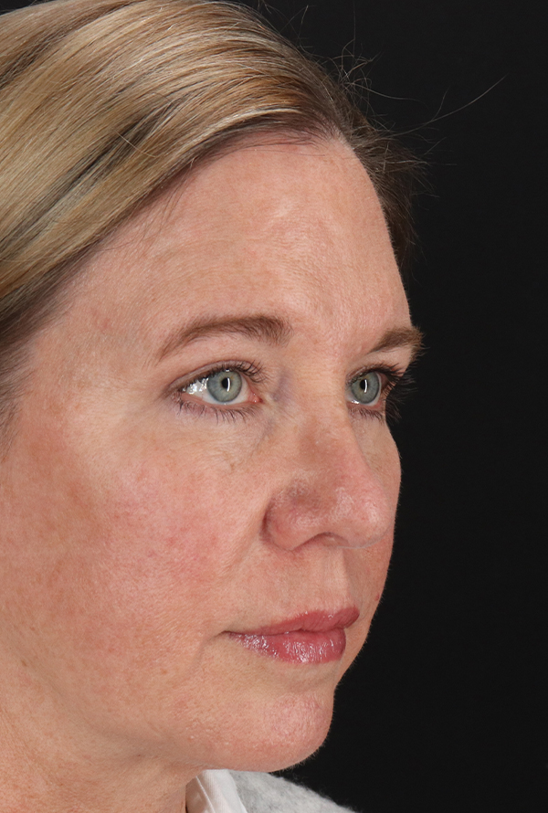 After - right_oblique