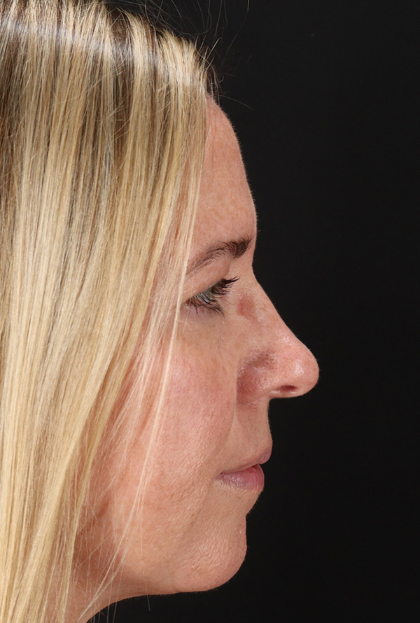 Before - right_lateral