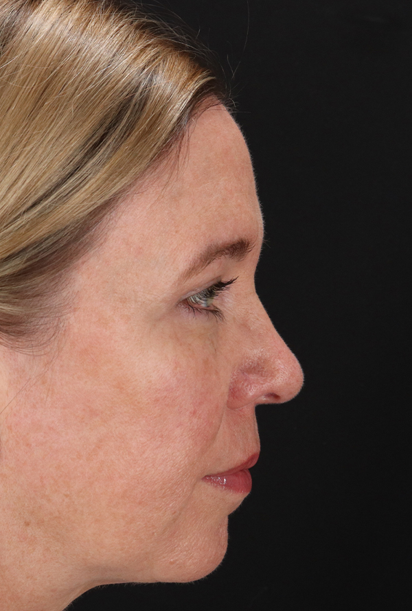 After - right_lateral