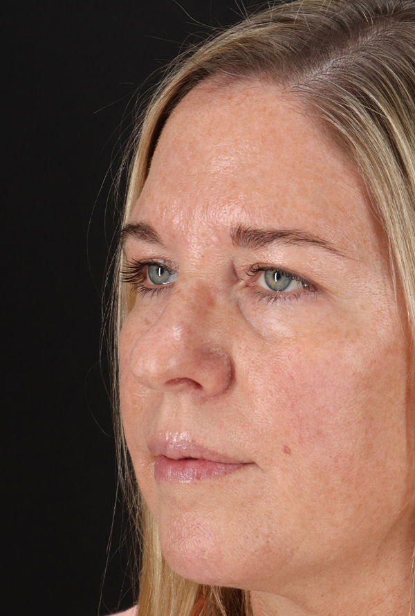 Before - left_oblique