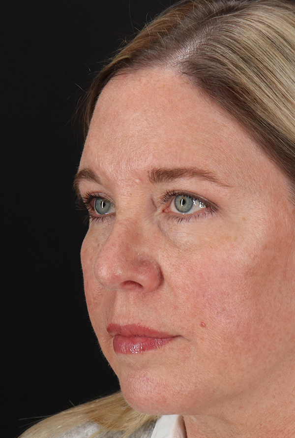 After - left_oblique