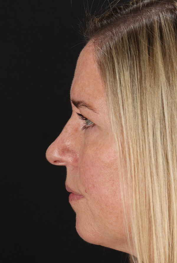 Before - left_lateral