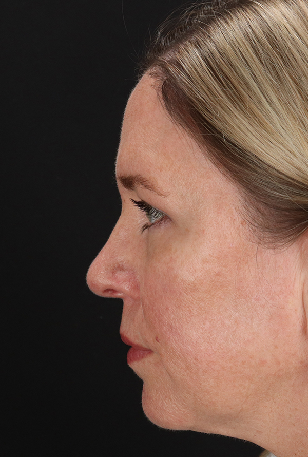 After - left_lateral