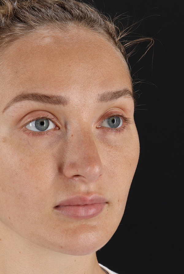 Before - right_oblique