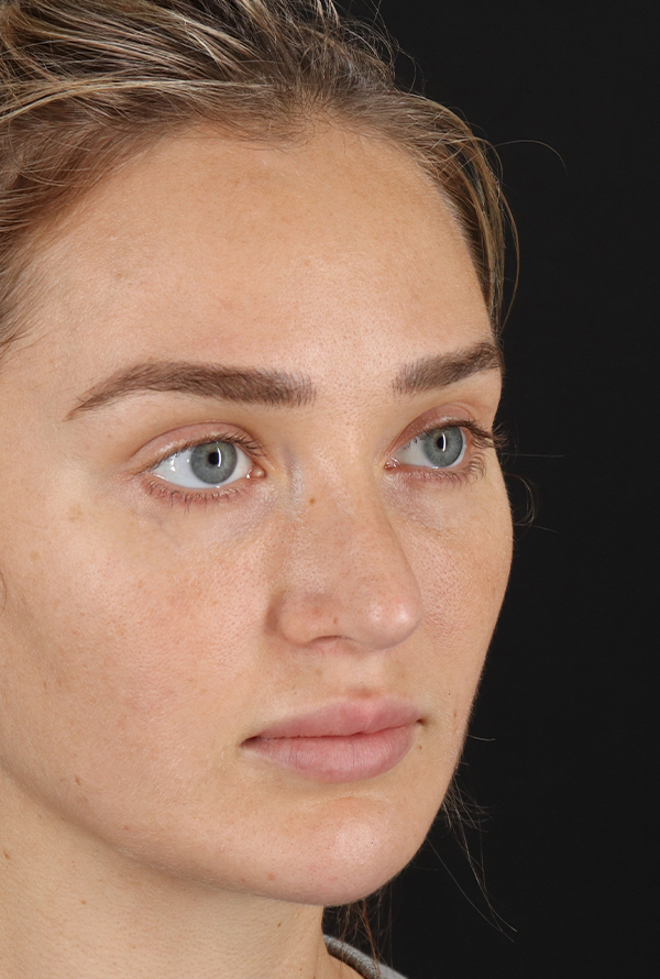 After - right_oblique