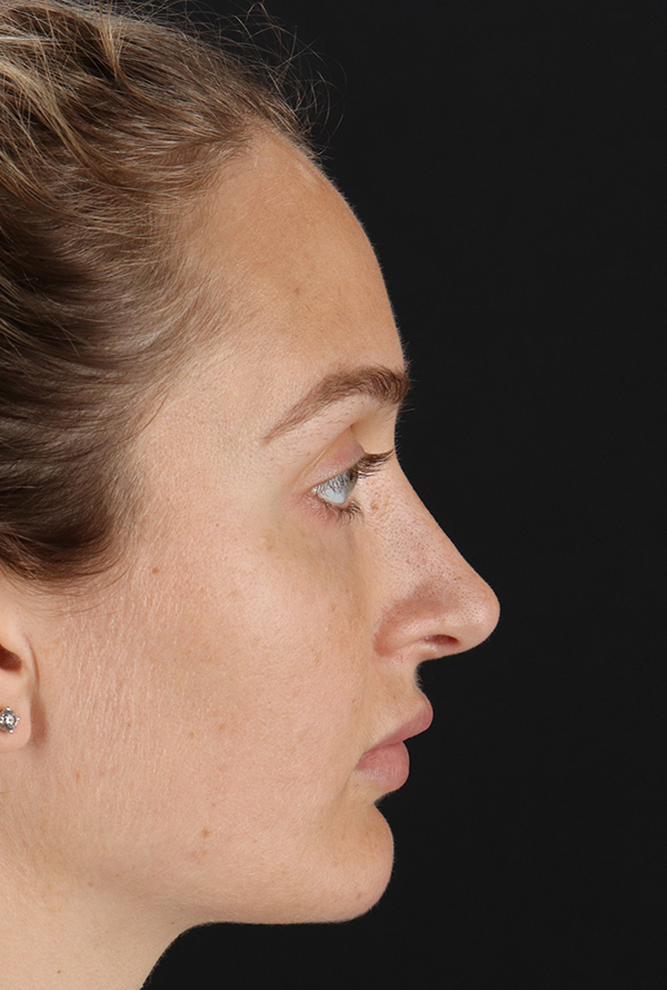 Before - right_lateral