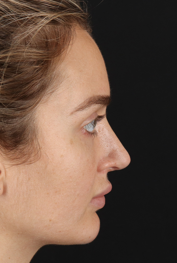 After - right_lateral