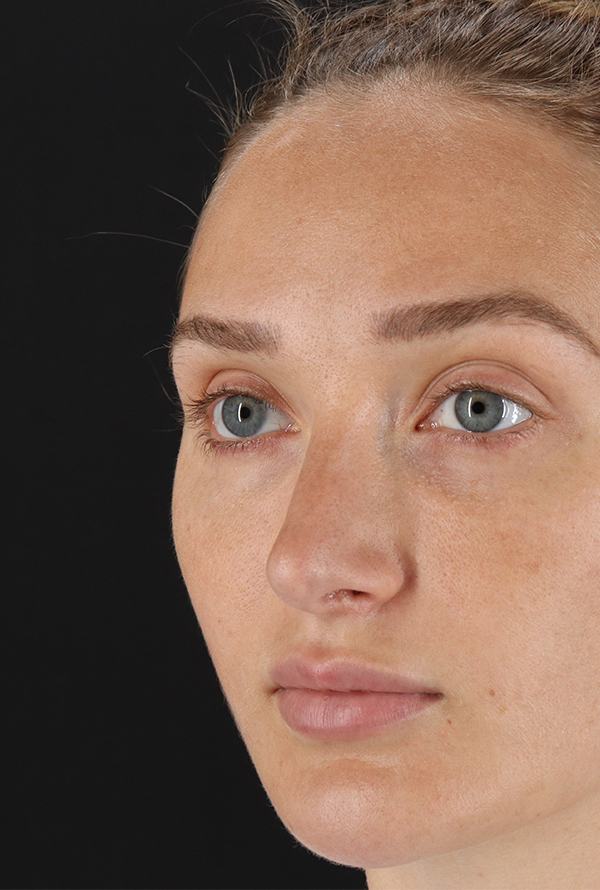 Before - left_oblique