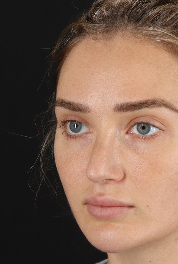 After - left_oblique