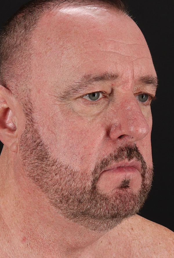 Before - right_oblique