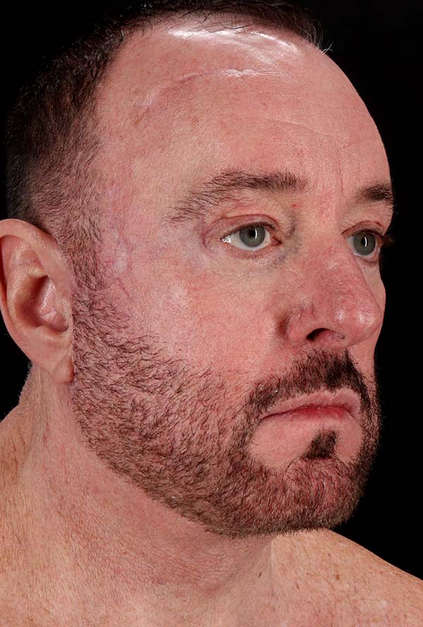 After - right_oblique