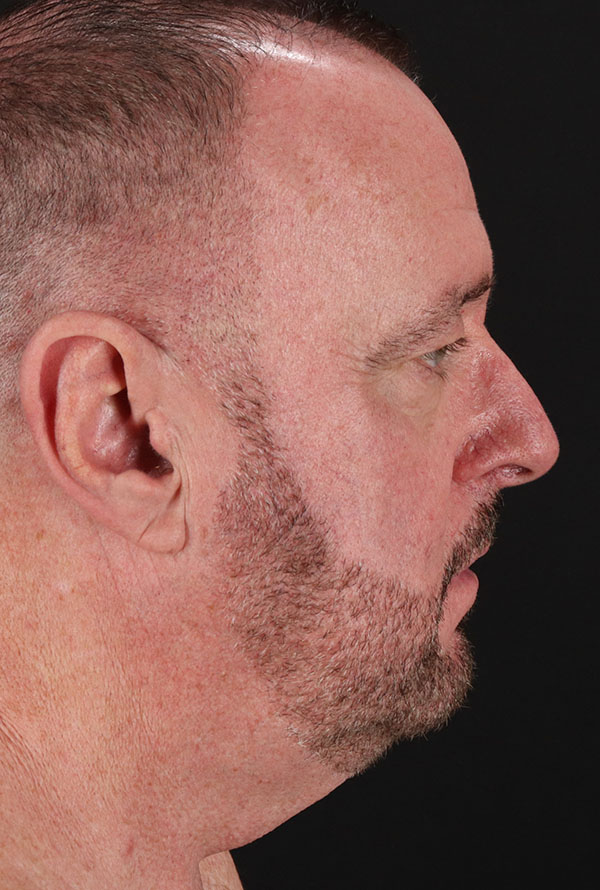 Before - right_lateral