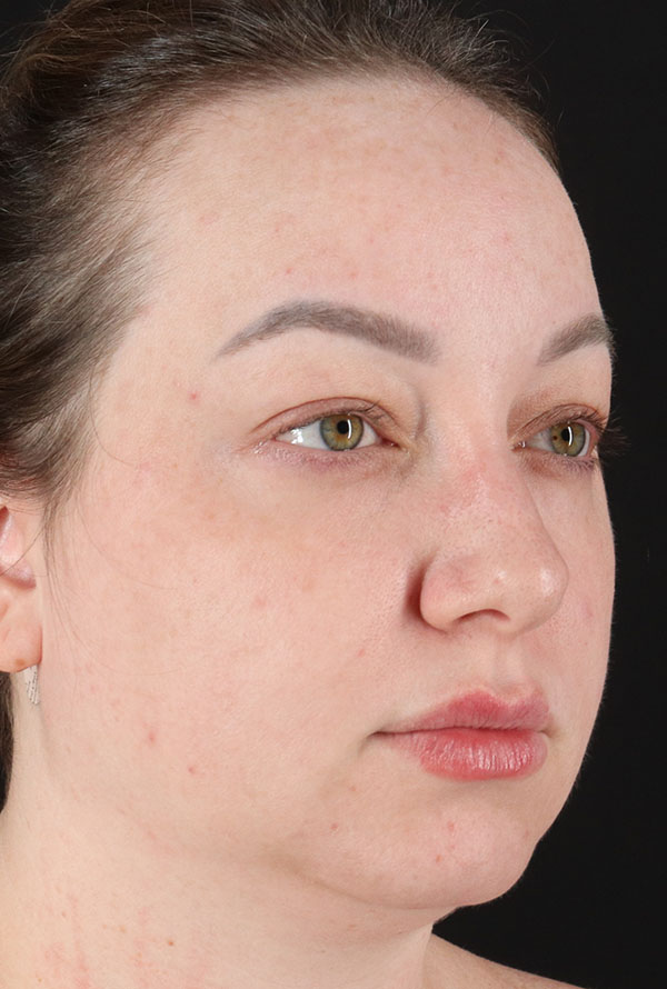 Before - right_oblique