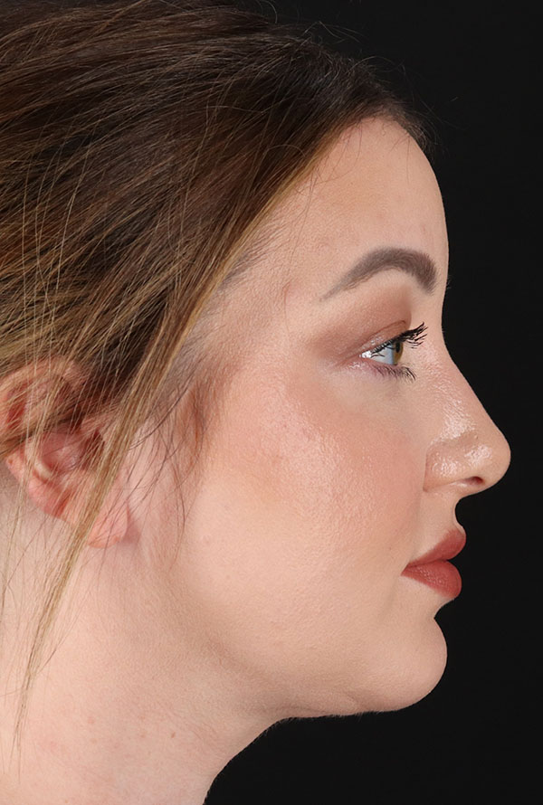 After - right_lateral