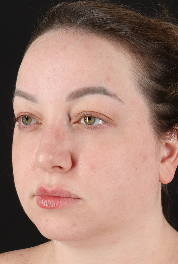 Before - left_oblique