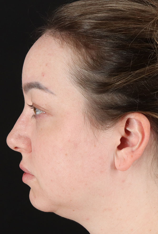 Before - left_lateral