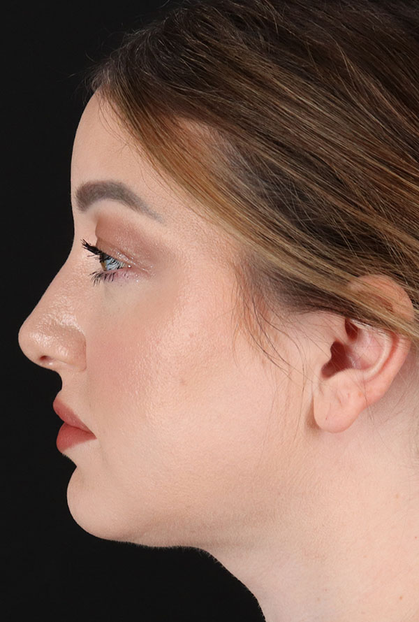 After - left_lateral