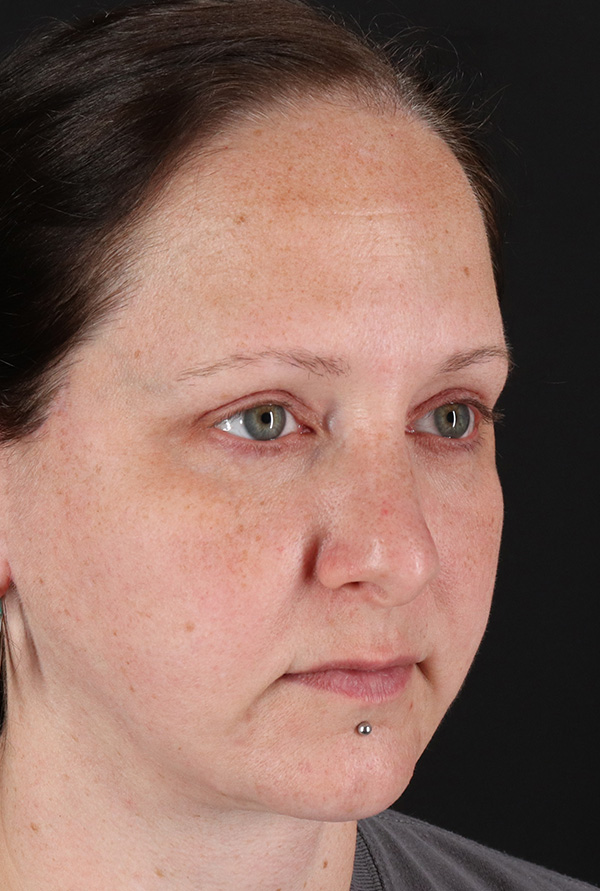 After - right_oblique