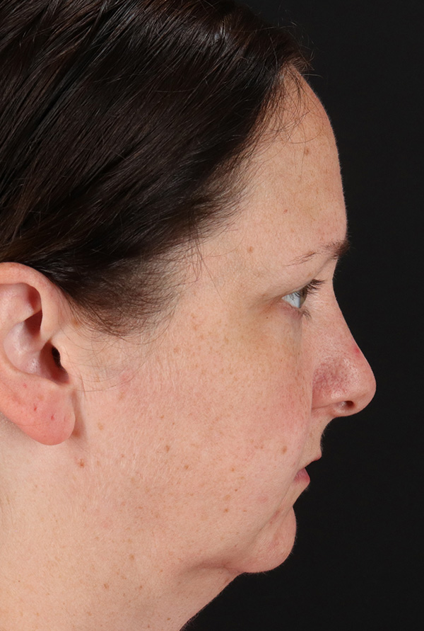 Before - right_lateral