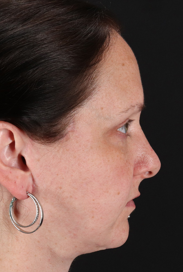 After - right_lateral