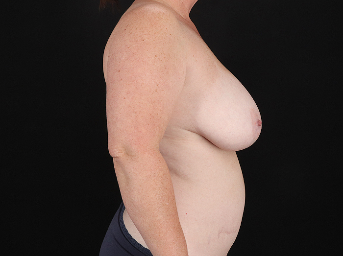 Before - right_lateral