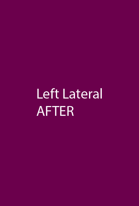 After - left_lateral