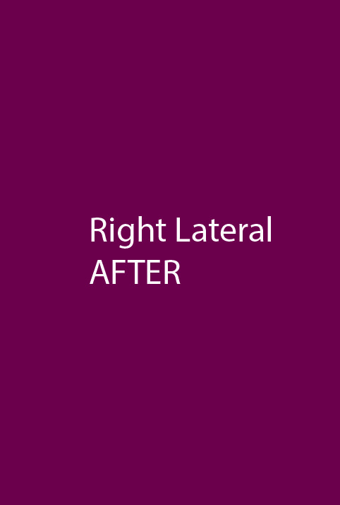 After - right_lateral
